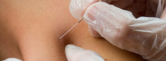 What is Dry Needling Physical Therapy?