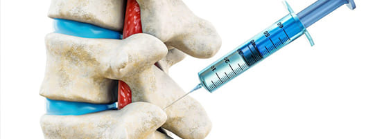 Facet Injections for Herniated Discs & Nerve Pain