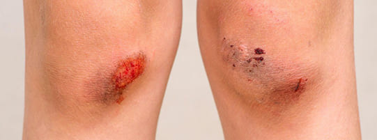 What Are the Most Common Leg Injuries From an Auto Accident?