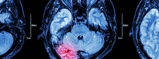 What Are the Different Types and Levels of Brain Injuries?