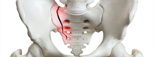 How Do You Know If You Have a Fractured Sacrum? Warning Signs & Treatments