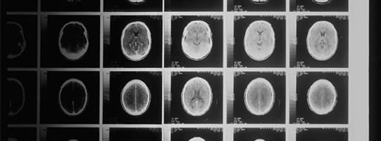 What Techniques Are Used in Diagnosing Traumatic Brain Injuries?