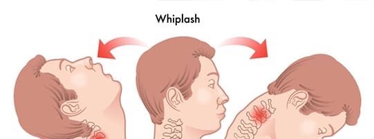 What Are the Different Stages of Whiplash and How Are They Treated?