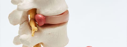 Have A Herniated Disc From An Accident? Consider A Percutaneous Discectomy