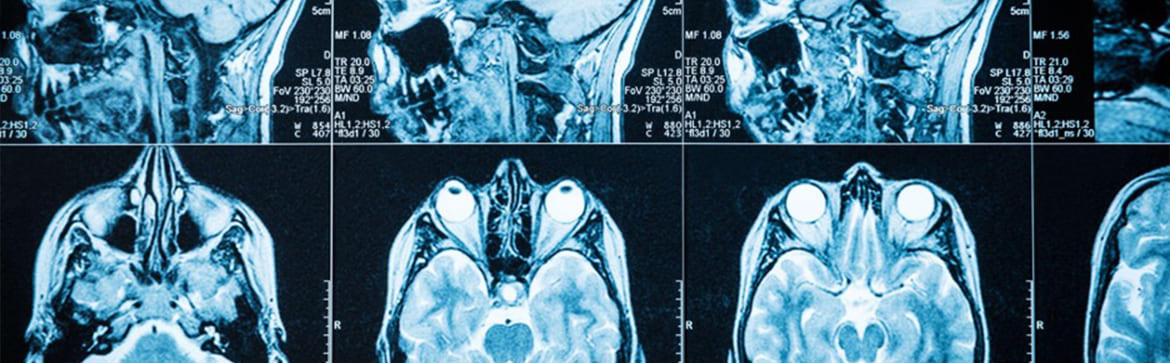 CT Scans for Diagnosing TBIs – How They Work & What to Expect